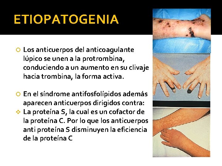 ETIOPATOGENIA Los anticuerpos del anticoagulante lúpico se unen a la protrombina, conduciendo a un