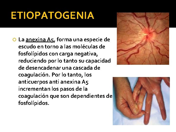 ETIOPATOGENIA La anexina A 5, forma una especie de escudo en torno a las