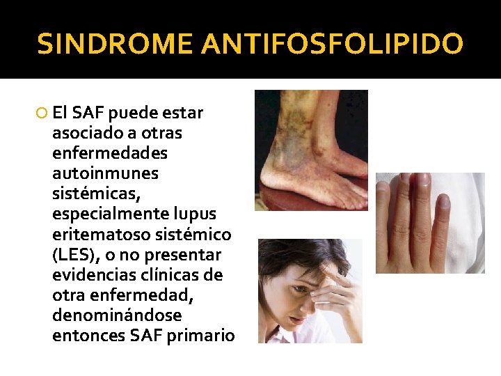 SINDROME ANTIFOSFOLIPIDO El SAF puede estar asociado a otras enfermedades autoinmunes sistémicas, especialmente lupus