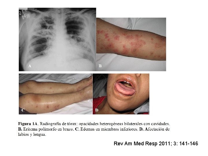 Rev Am Med Resp 2011; 3: 141 -146 