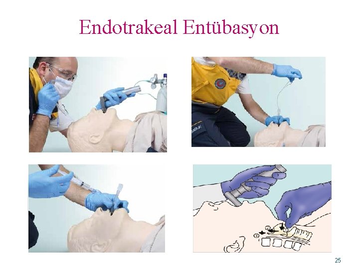 Endotrakeal Entübasyon 25 