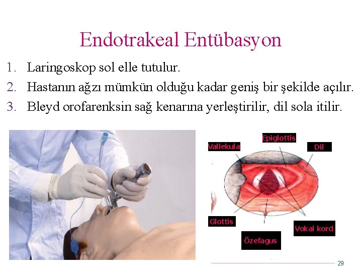 Endotrakeal Entübasyon 1. Laringoskop sol elle tutulur. 2. Hastanın ağzı mümkün olduğu kadar geniş