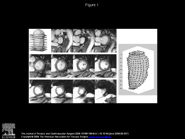 Figure 1 The Journal of Thoracic and Cardiovascular Surgery 2009 137887 -894 DOI: (10.