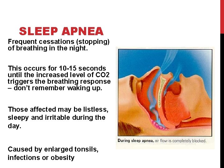 SLEEP APNEA Frequent cessations (stopping) of breathing in the night. This occurs for 10