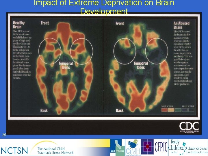 Impact of Extreme Deprivation on Brain Development 25 