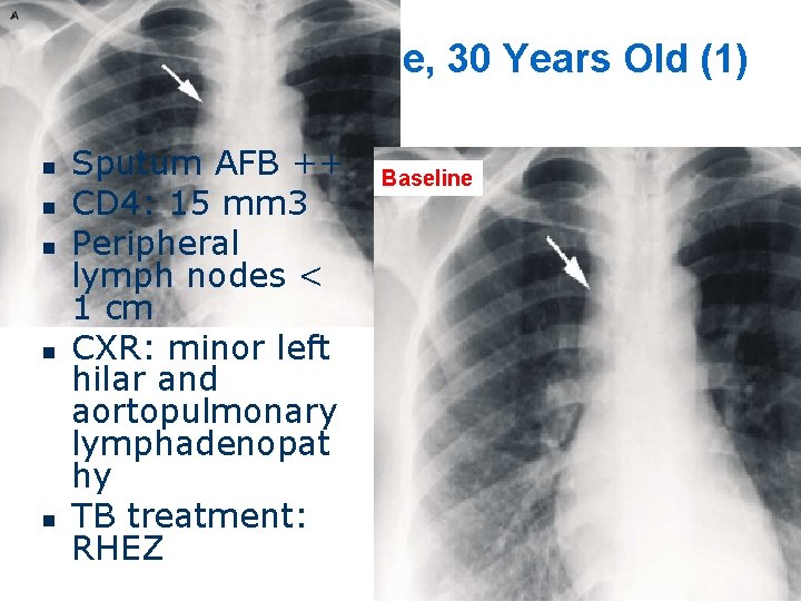 Case 2: Hung, Male, 30 Years Old (1) n n n Sputum AFB ++