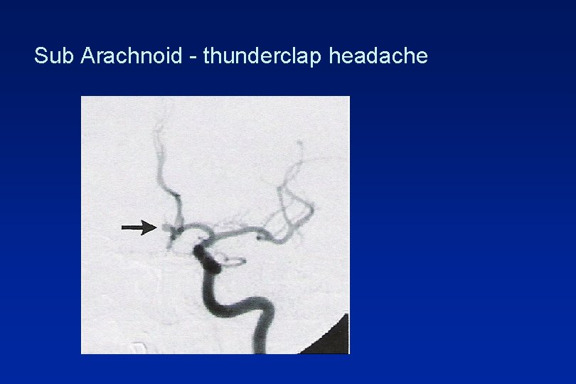 Sub Arachnoid - thunderclap headache 