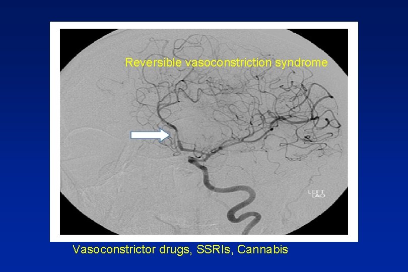 Reversible vasoconstriction syndrome Vasoconstrictor drugs, SSRIs, Cannabis 