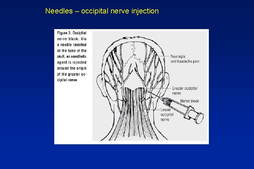 Needles – occipital nerve injection 