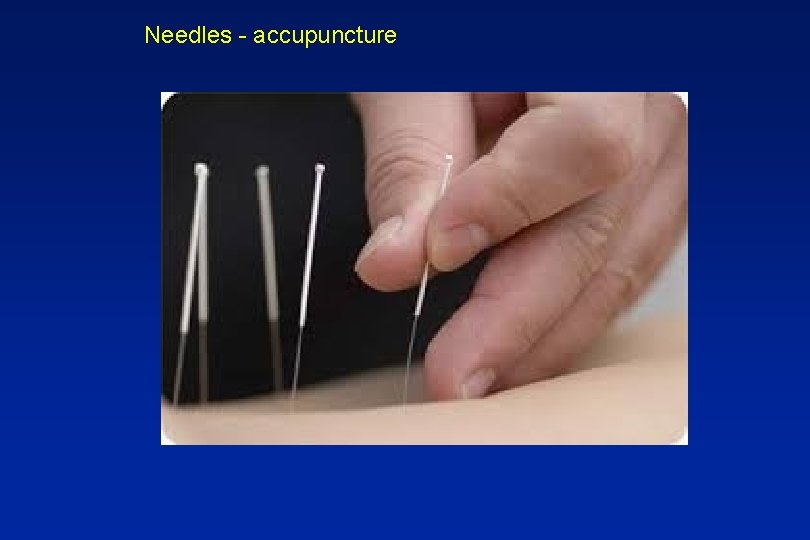 Needles - accupuncture 