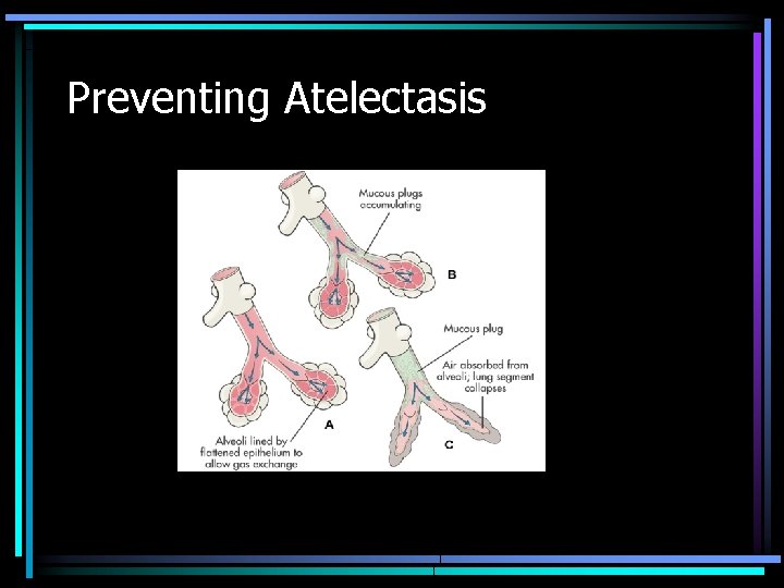 Preventing Atelectasis 