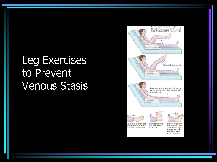 Leg Exercises to Prevent Venous Stasis 