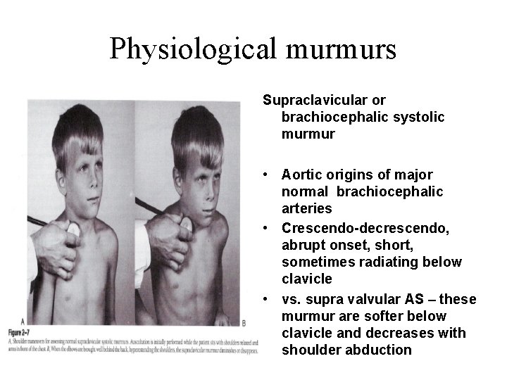 Physiological murmurs Supraclavicular or brachiocephalic systolic murmur • Aortic origins of major normal brachiocephalic