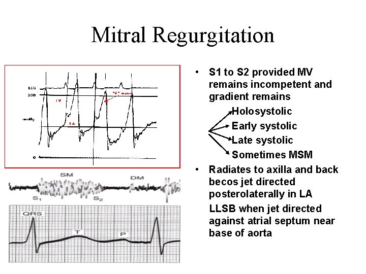 Mitral Regurgitation • S 1 to S 2 provided MV remains incompetent and gradient