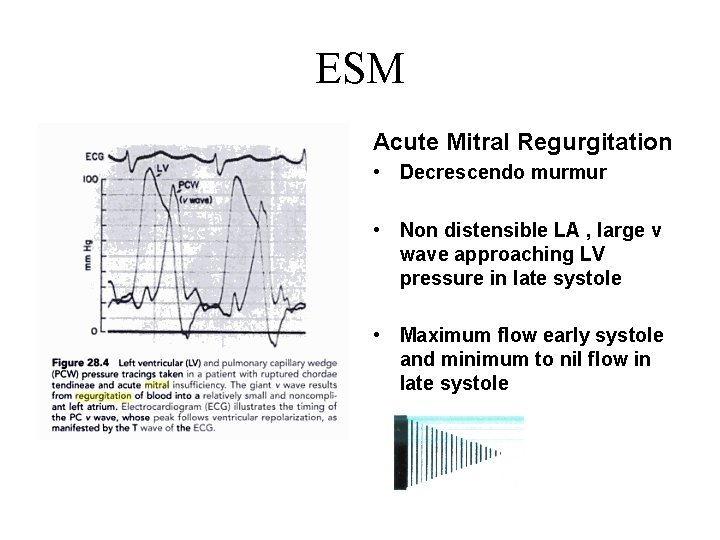 ESM Acute Mitral Regurgitation • Decrescendo murmur • Non distensible LA , large v