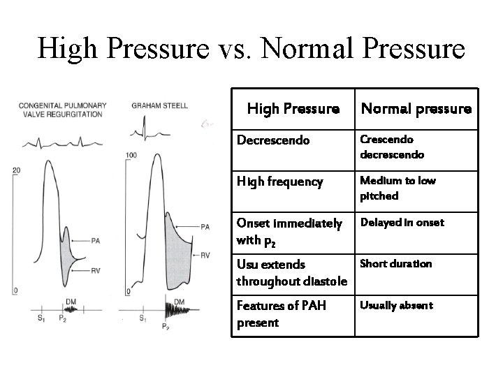 High Pressure vs. Normal Pressure High Pressure Normal pressure Decrescendo Crescendo decrescendo High frequency
