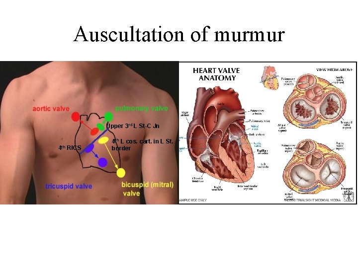 Auscultation of murmur Upper 3 rd L St-C Jn 4 th RICS 4 th