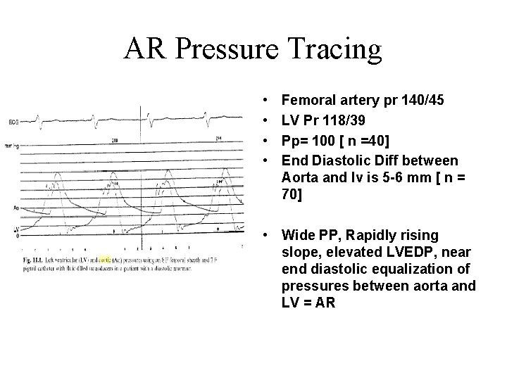 AR Pressure Tracing • • Femoral artery pr 140/45 LV Pr 118/39 Pp= 100