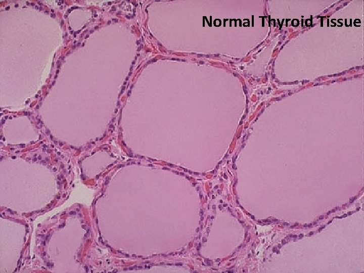 Normal Thyroid Tissue 