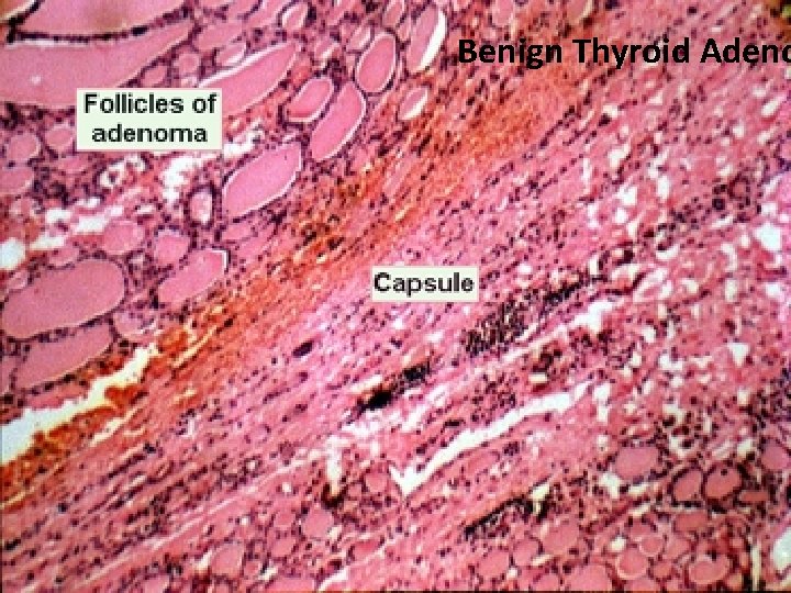 Benign Thyroid Adeno 