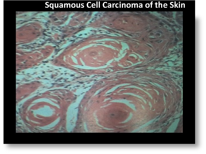 Squamous Cell Carcinoma of the Skin 