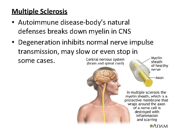 Multiple Sclerosis • Autoimmune disease-body’s natural defenses breaks down myelin in CNS • Degeneration