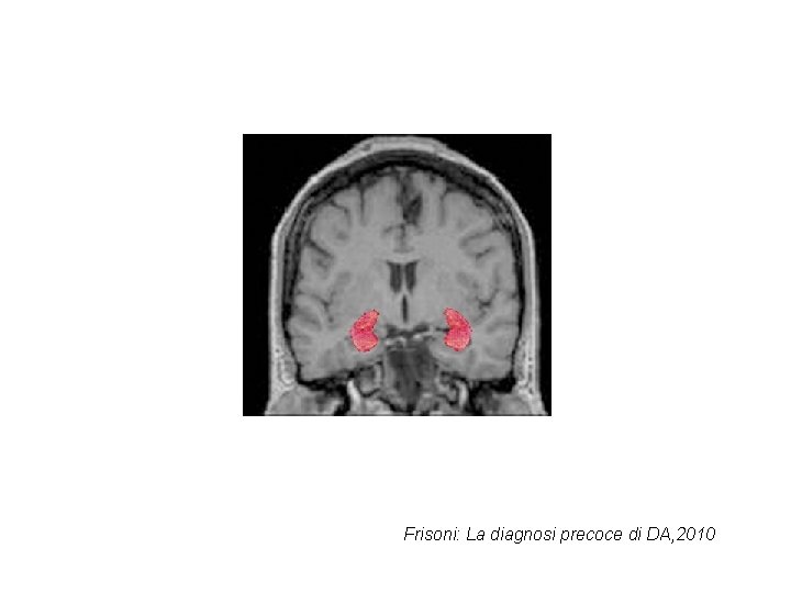 Frisoni: La diagnosi precoce di DA, 2010 