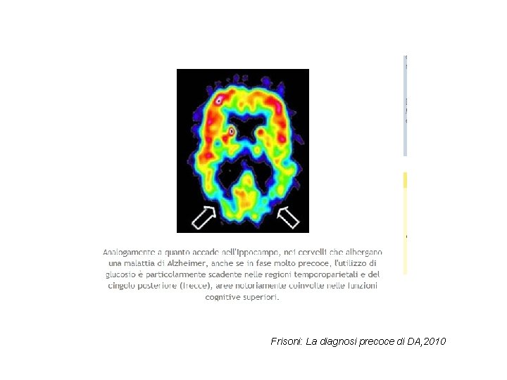 Frisoni: La diagnosi precoce di DA, 2010 