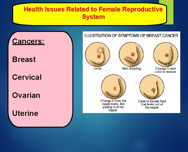 Health Issues Related to Female Reproductive System Cancers: Breast Cervical Ovarian Uterine 