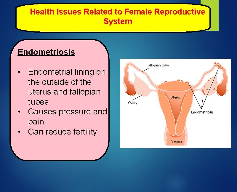 Health Issues Related to Female Reproductive System Endometriosis • Endometrial lining on the outside