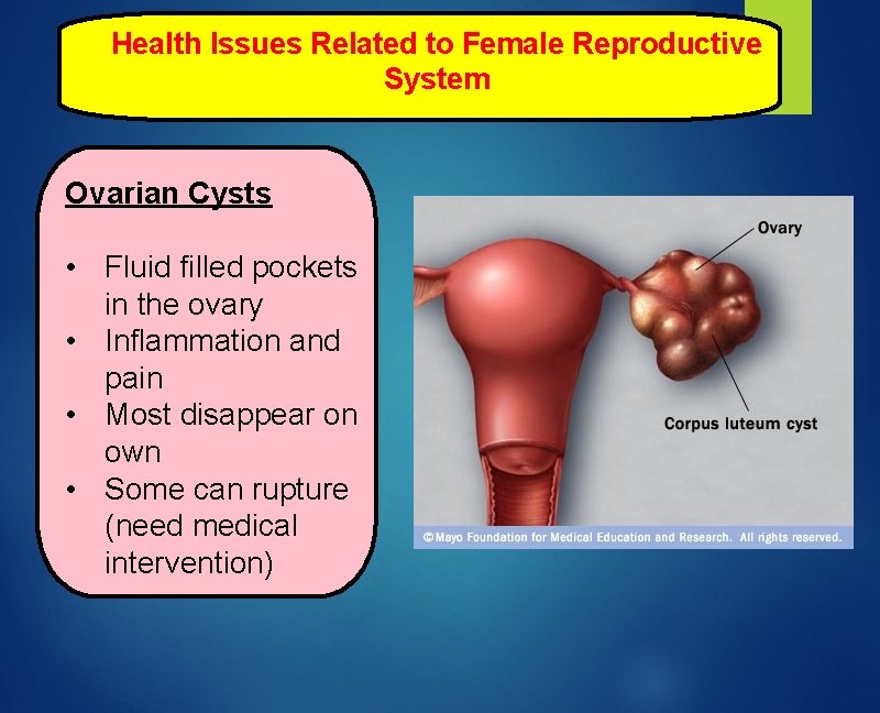 Health Issues Related to Female Reproductive System Ovarian Cysts • Fluid filled pockets in