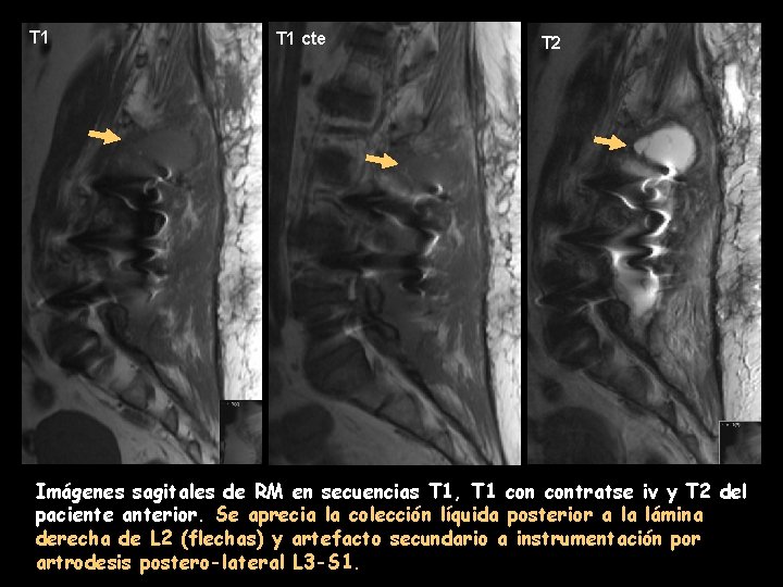 T 1 cte T 2 Imágenes sagitales de RM en secuencias T 1, T