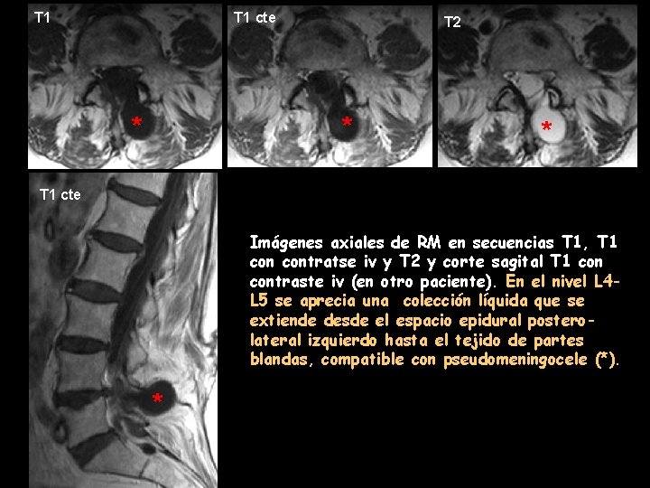 T 1 cte * T 2 * * T 1 cte Imágenes axiales de