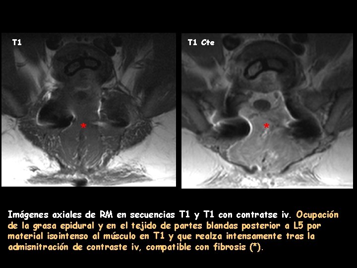 T 1 Cte * * Imágenes axiales de RM en secuencias T 1 y