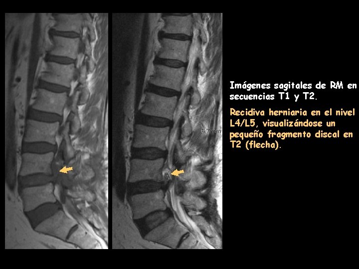 Imágenes sagitales de RM en secuencias T 1 y T 2. Recidiva herniaria en