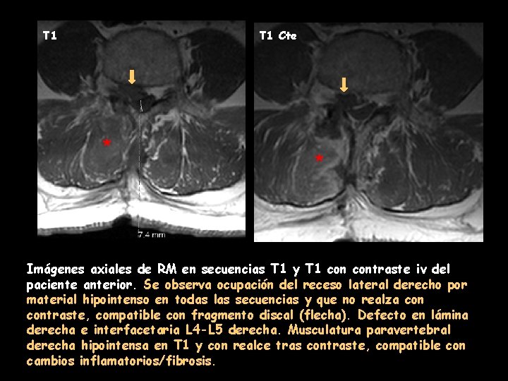 T 1 Cte * * Imágenes axiales de RM en secuencias T 1 y