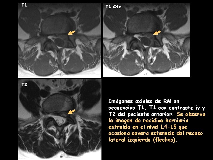 T 1 Cte T 2 Imágenes axiales de RM en secuencias T 1, T