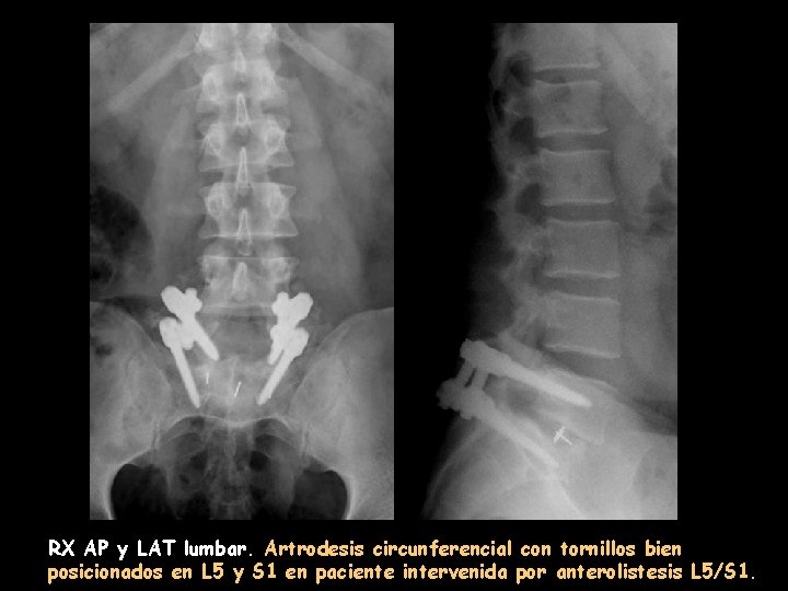 RX AP y LAT lumbar. Artrodesis circunferencial con tornillos bien posicionados en L 5