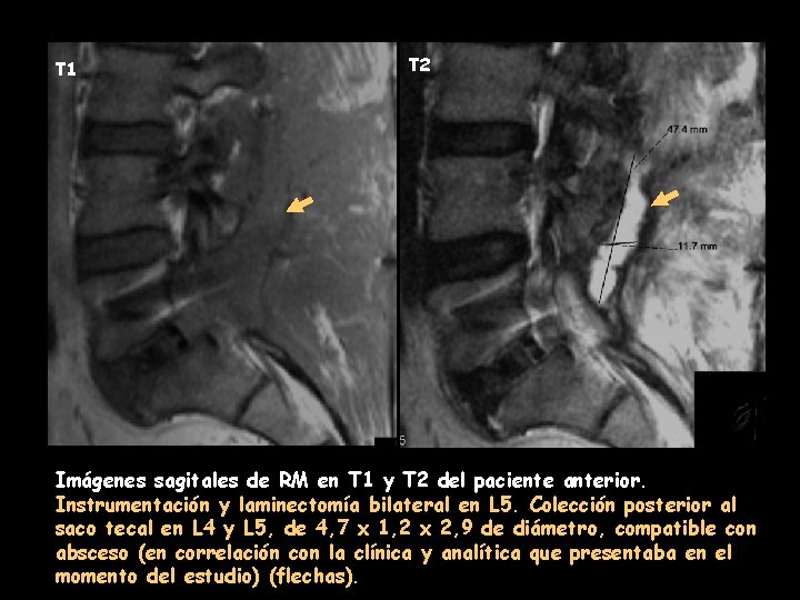 T 1 T 2 Imágenes sagitales de RM en T 1 y T 2