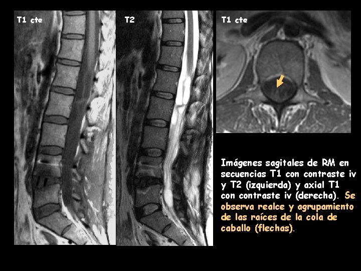 T 1 cte T 2 T 1 cte Imágenes sagitales de RM en secuencias