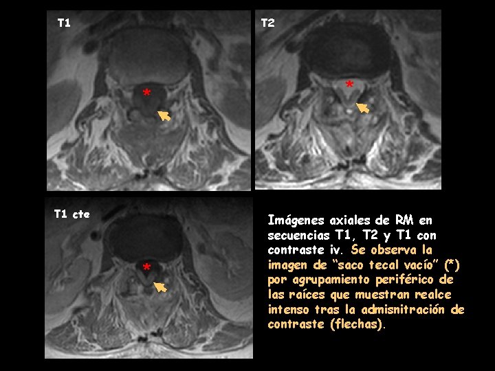 T 1 T 2 * T 1 cte * * Imágenes axiales de RM