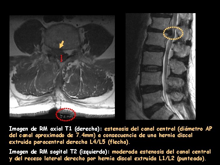 Imagen de RM axial T 1 (derecha): estenosis del canal central (diámetro AP del