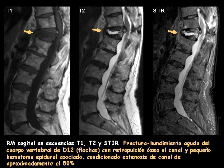 T 1 T 2 STIR RM sagital en secuencias T 1, T 2 y