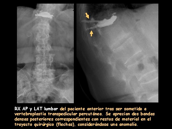 RX AP y LAT lumbar del paciente anterior tras ser sometido a vertebroplastia transpedicular