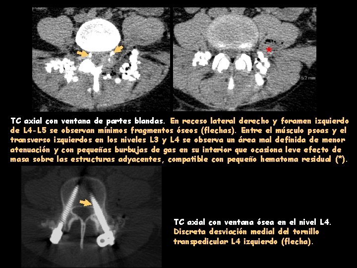 * TC axial con ventana de partes blandas. En receso lateral derecho y foramen