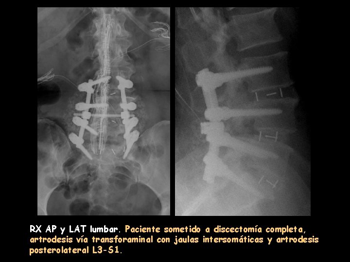 RX AP y LAT lumbar. Paciente sometido a discectomía completa, artrodesis vía transforaminal con