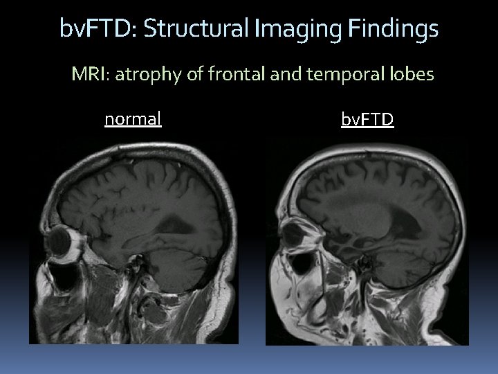 bv. FTD: Structural Imaging Findings MRI: atrophy of frontal and temporal lobes normal bv. bv. FTD: Structural Imaging Findings MRI: atrophy of frontal and temporal lobes normal bv.
