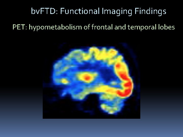 bv. FTD: Functional Imaging Findings PET: hypometabolism of frontal and temporal lobes bv. FTD: Functional Imaging Findings PET: hypometabolism of frontal and temporal lobes