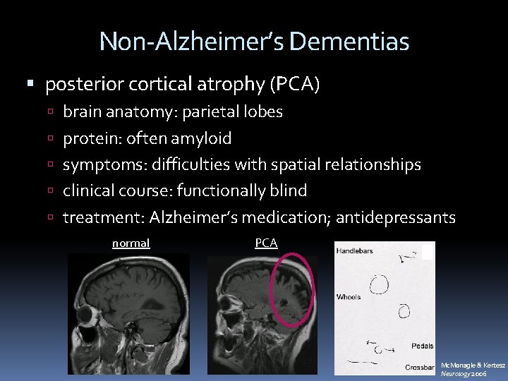 Non-Alzheimer’s Dementias posterior cortical atrophy (PCA) brain anatomy: parietal lobes protein: often amyloid symptoms: Non-Alzheimer’s Dementias posterior cortical atrophy (PCA) brain anatomy: parietal lobes protein: often amyloid symptoms: