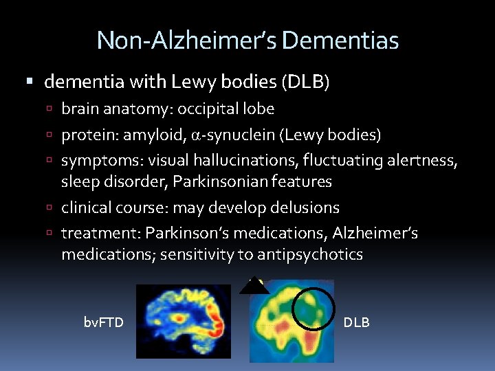 Non-Alzheimer’s Dementias dementia with Lewy bodies (DLB) brain anatomy: occipital lobe protein: amyloid, α-synuclein Non-Alzheimer’s Dementias dementia with Lewy bodies (DLB) brain anatomy: occipital lobe protein: amyloid, α-synuclein